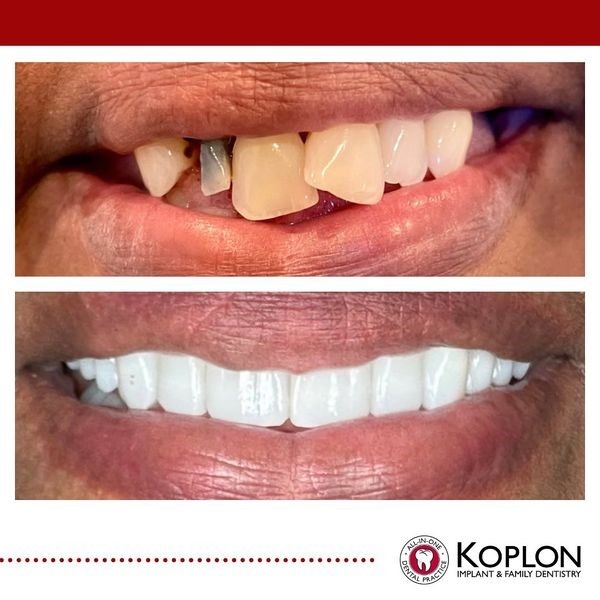 koplon-dental-implants-4-1